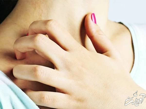 خارش گردن بر اثر آفتاب خارش گردن